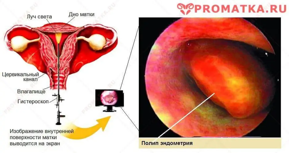 Забеременеть после удаления полипа в матке. Гиперпластические процессы эндометрия гистероскопия. Пóлип в полости матки аденоматозный. Полип эндометрия в матке.