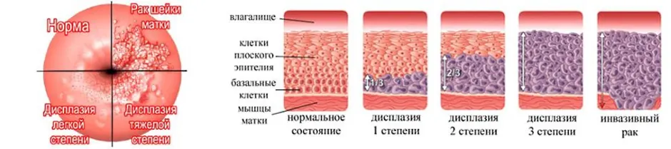 Сосудистый рисунок выражен в матке что это значит