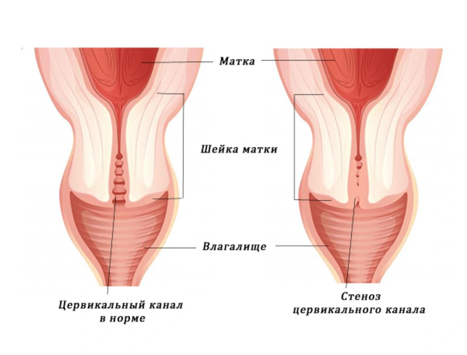 Уретра и цервикальный канал