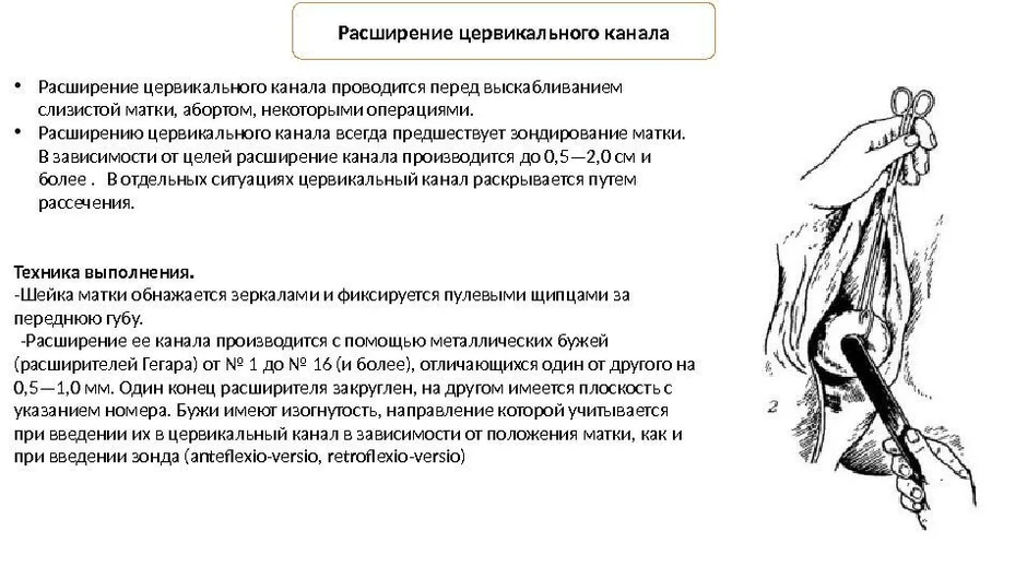 Матка каналы. Сращение цервикального канала что это. Стеноз цервикального канала протокол. Бужирование цервикального канала. Стриктура наружного зева шейки матки.