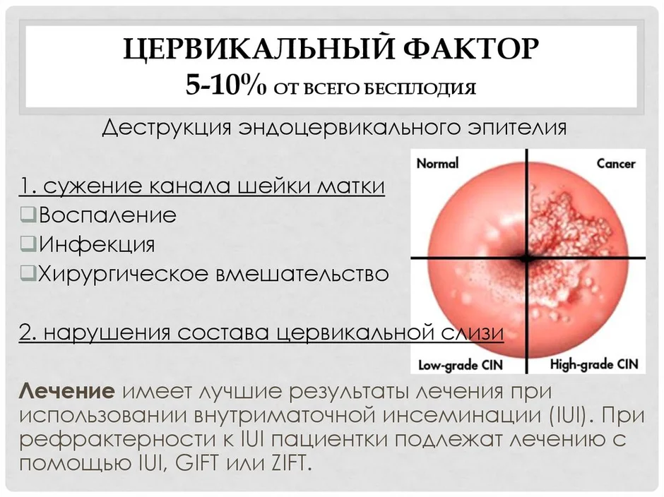 Цервикальный канал у женщин где находится и что это такое рисунок