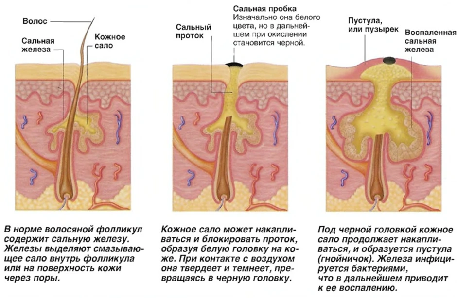 Типы пор на коже